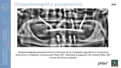 trascigomaticos_e_Implantes_Phibo_TSA
