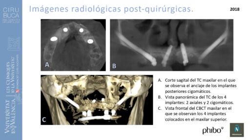 trascigomaticos_e_Implantes_Phibo_TSA