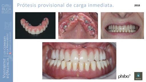 trascigomaticos_e_Implantes_Phibo_TSA
