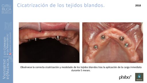 trascigomaticos_e_Implantes_Phibo_TSA