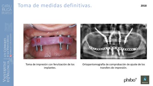trascigomaticos_e_Implantes_Phibo_TSA