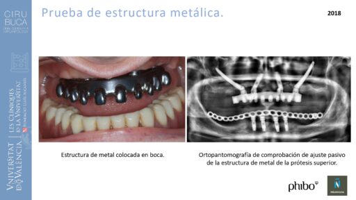 trascigomaticos_e_Implantes_Phibo_TSA