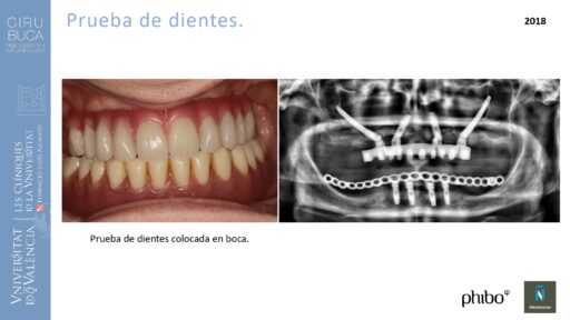 trascigomaticos_e_Implantes_Phibo_TSA