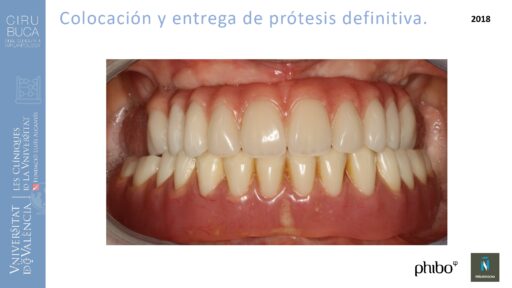 trascigomaticos_e_Implantes_Phibo_TSA