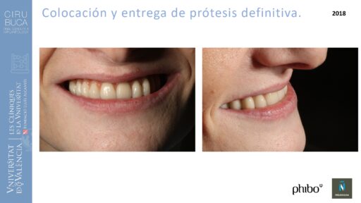 trascigomaticos_e_Implantes_Phibo_TSA