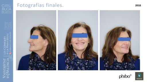 trascigomaticos_e_Implantes_Phibo_TSA