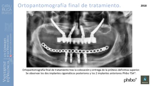 trascigomaticos_e_Implantes_Phibo_TSA