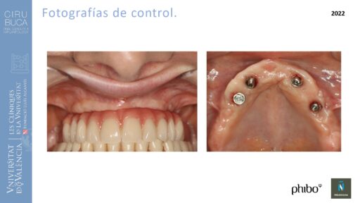 trascigomaticos_e_Implantes_Phibo_TSA