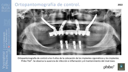 trascigomaticos_e_Implantes_Phibo_TSA