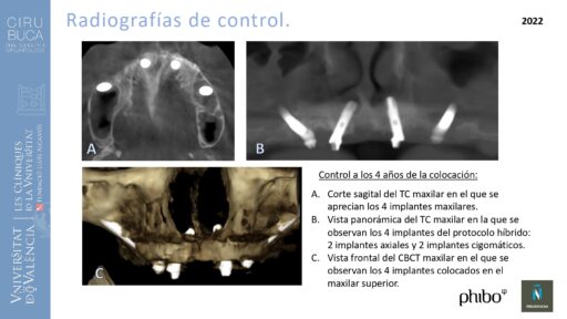 trascigomaticos_e_Implantes_Phibo_TSA