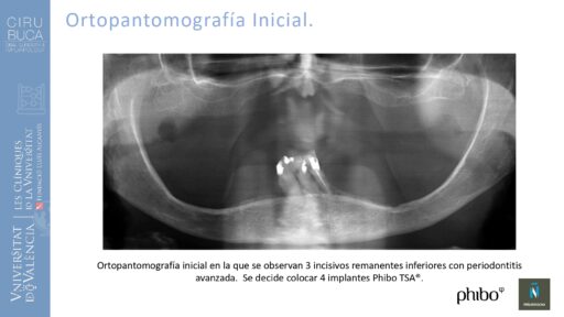 Victoria Bruscas_cirugia_periapical_periimplantaria