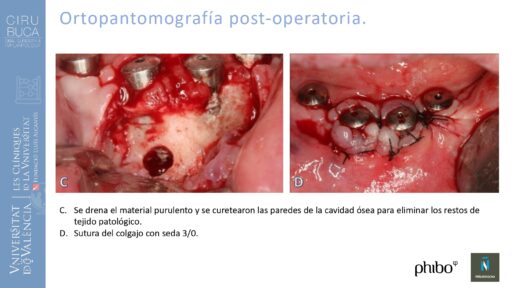 Victoria Bruscas_cirugia_periapical_periimplantaria