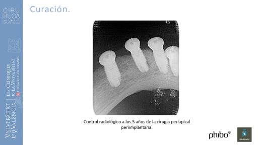 Victoria Bruscas_cirugia_periapical_periimplantaria