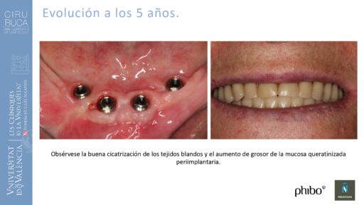 Victoria Bruscas_cirugia_periapical_periimplantaria
