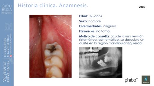quistectomia-e-implantes-phibo-
