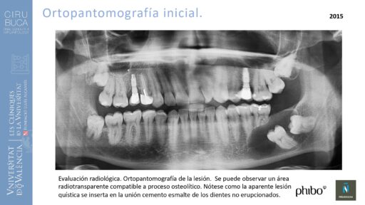 quistectomia-e-implantes-phibo-