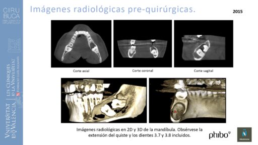 quistectomia-e-implantes-phibo-
