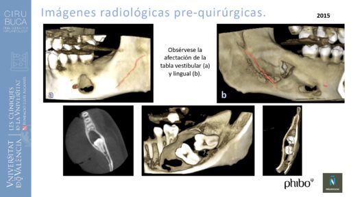 quistectomia-e-implantes-phibo-