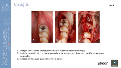 quistectomia-e-implantes-phibo-