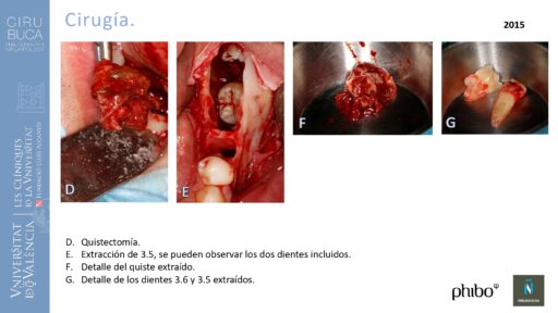 quistectomia-e-implantes-phibo-