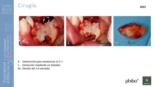 quistectomia-e-implantes-phibo-