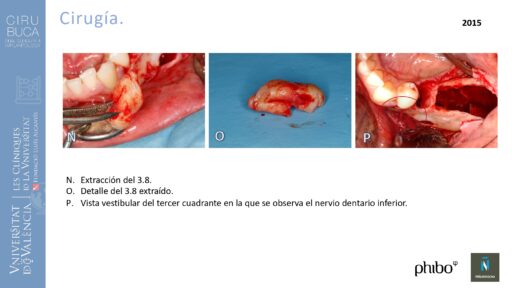 quistectomia-e-implantes-phibo-