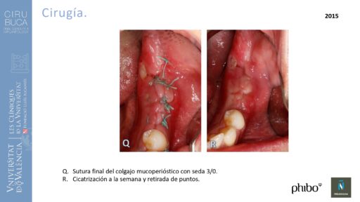 quistectomia-e-implantes-phibo-