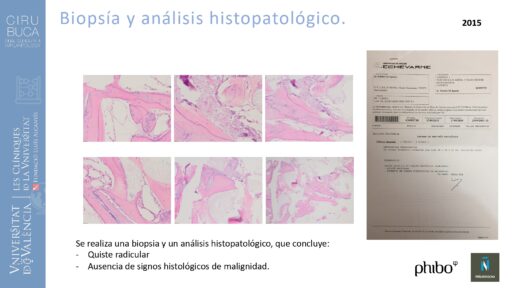 quistectomia-e-implantes-phibo-