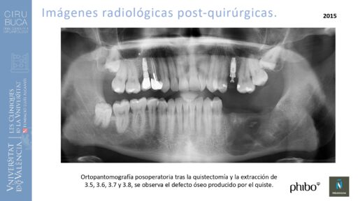 quistectomia-e-implantes-phibo-