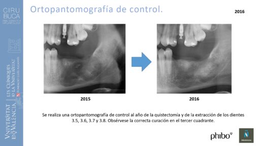 quistectomia-e-implantes-phibo-