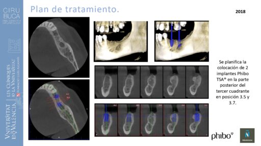 quistectomia-e-implantes-phibo-