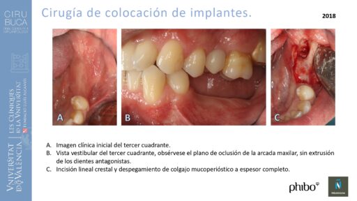 quistectomia-e-implantes-phibo-