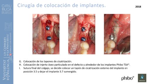quistectomia-e-implantes-phibo-