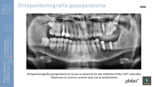 quistectomia-e-implantes-phibo-