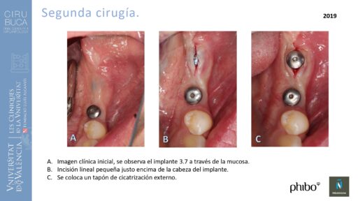 quistectomia-e-implantes-phibo-