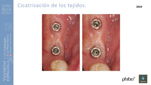 quistectomia-e-implantes-phibo-