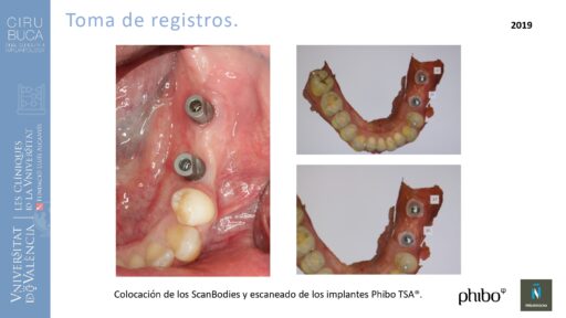 quistectomia-e-implantes-phibo-