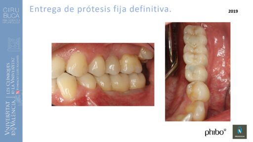 quistectomia-e-implantes-phibo-