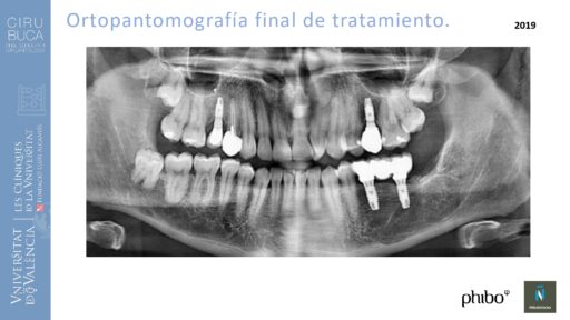 quistectomia-e-implantes-phibo-