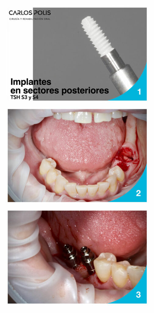 Carlos_Polis_Implantes_TSH_S3_S4_01