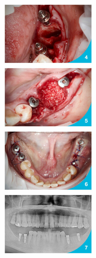 Carlos_Polis_Implantes_TSH_S3_S4_02