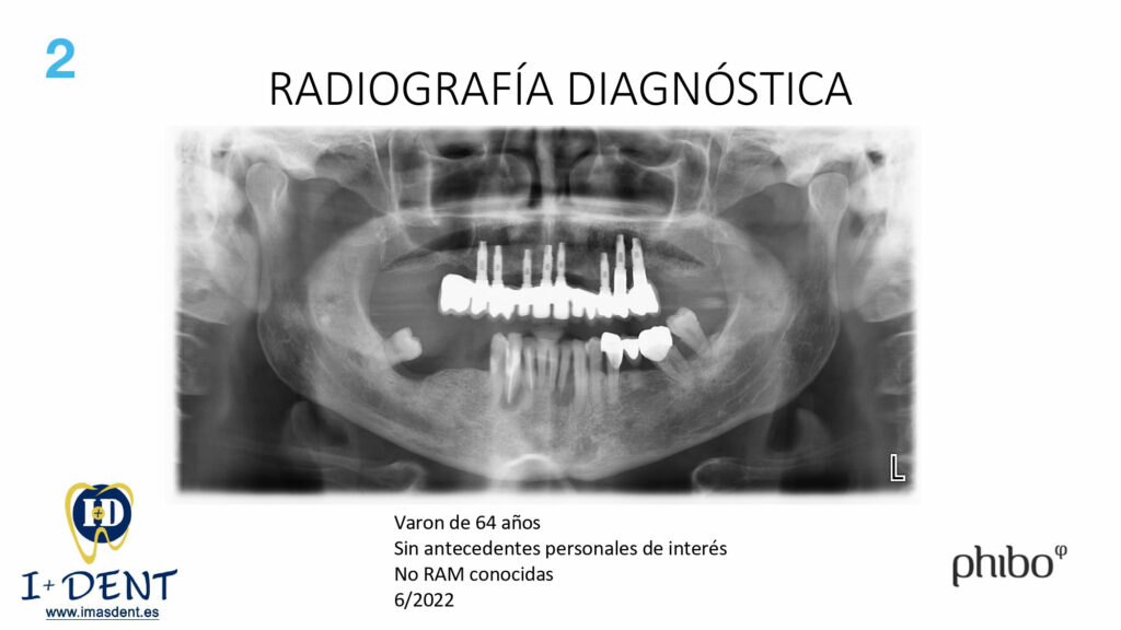 CARGA-INMEDIATA-Inferior-TSH-Oscar-Arias_0002
