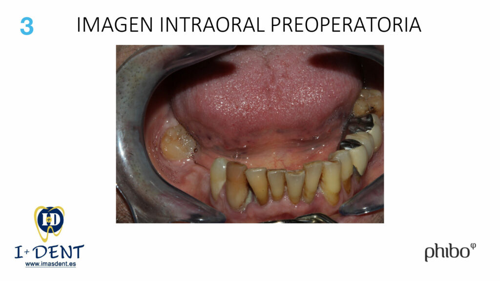 CARGA-INMEDIATA-Inferior-TSH-Oscar-Arias_0003