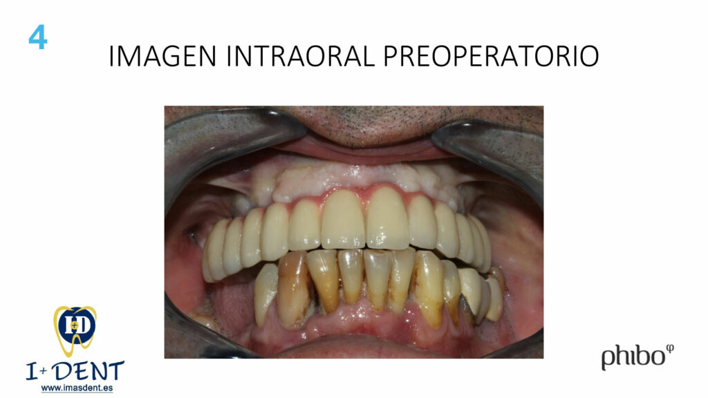 CARGA-INMEDIATA-Inferior-TSH-Oscar-Arias_0004