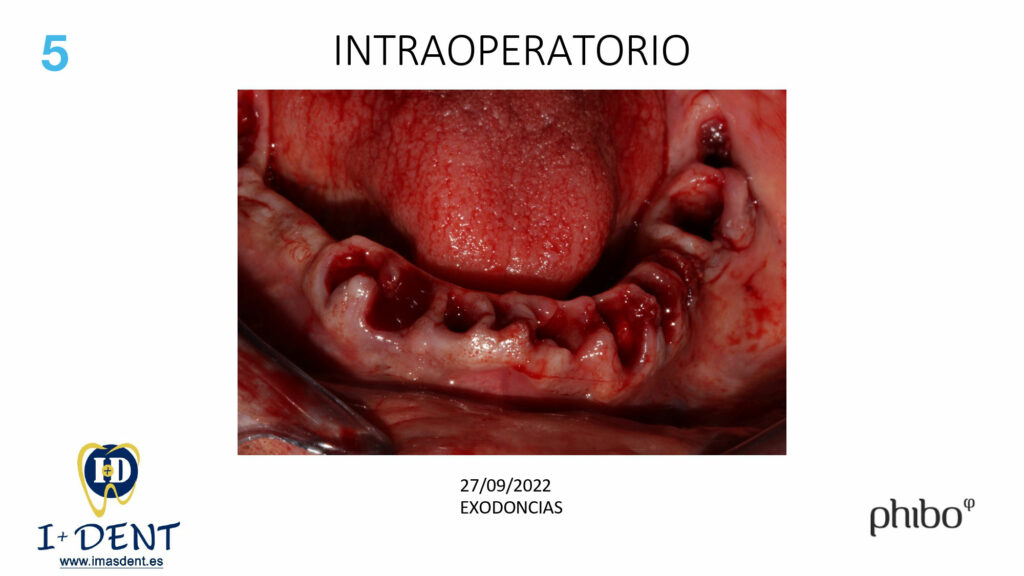 CARGA-INMEDIATA-Inferior-TSH-Oscar-Arias_0005