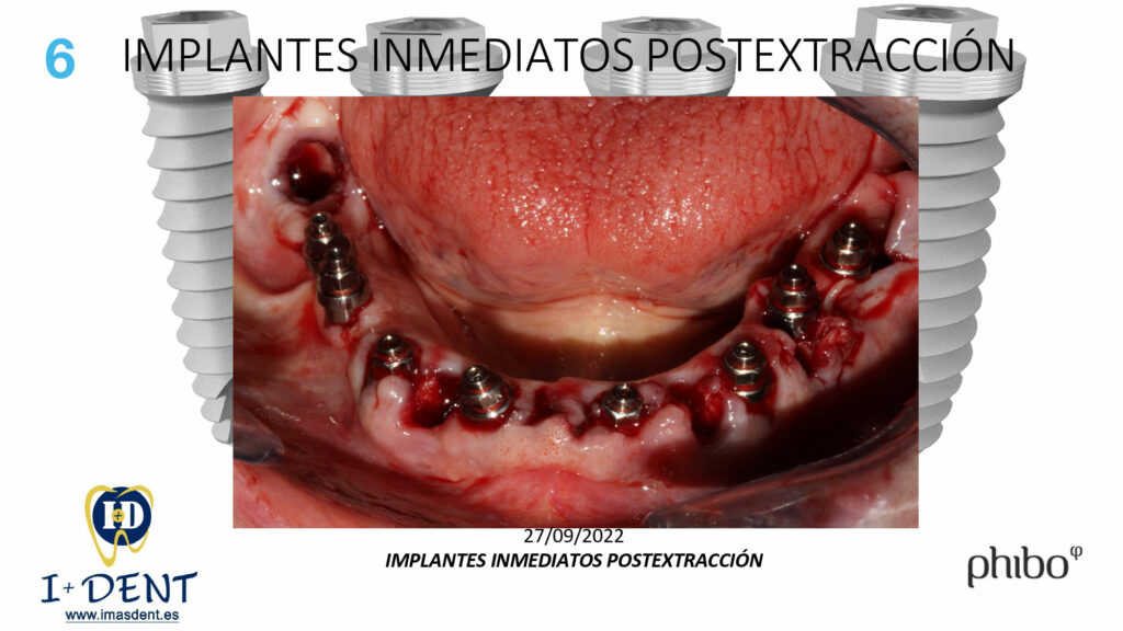 CARGA-INMEDIATA-Inferior-TSH-Oscar-Arias_0006