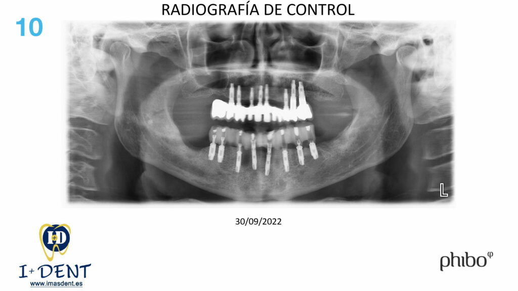 CARGA-INMEDIATA-Inferior-TSH-Oscar-Arias_0010