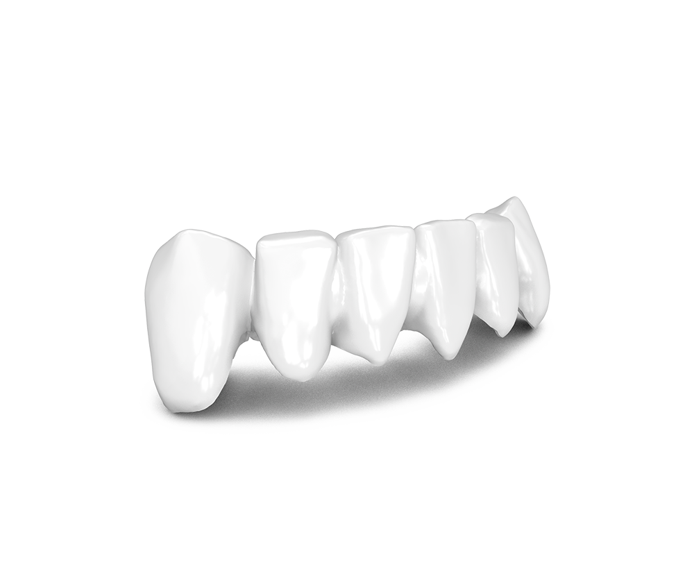 pmma-cronia-cementada