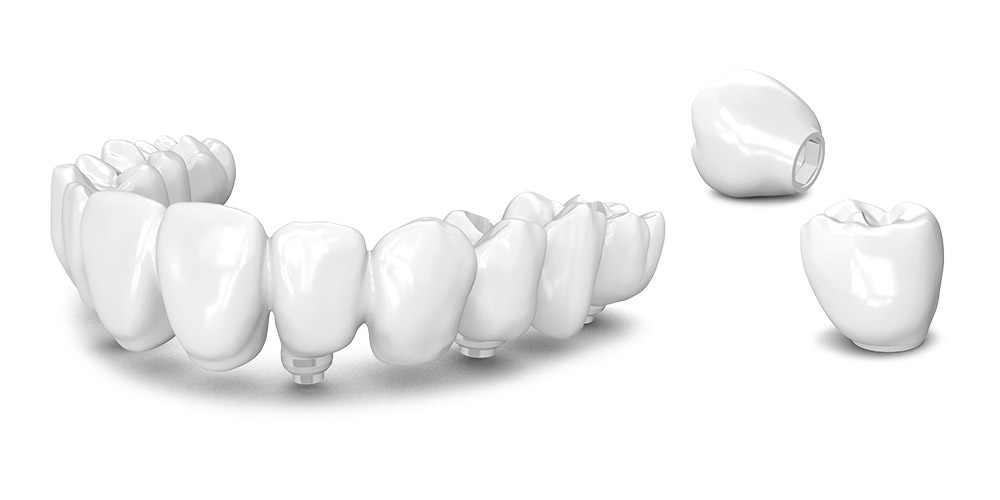 protesis-atorornillada-pmma
