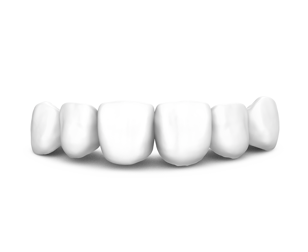 zirconia-phidia-cementada-multiple
